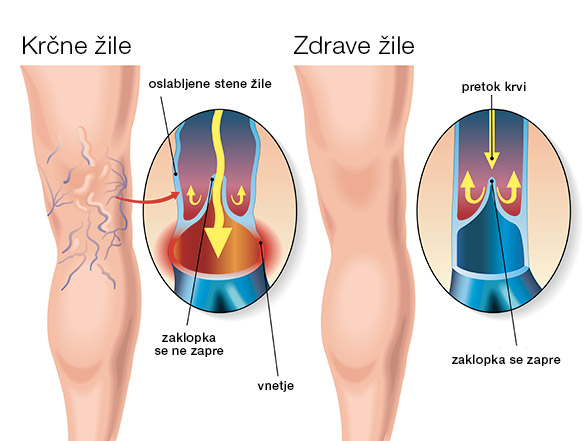 Krčne žile