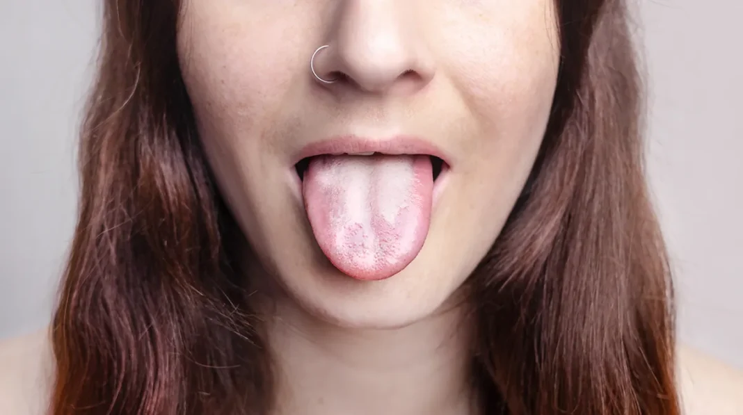 Kandida simptomi in zdravljenje