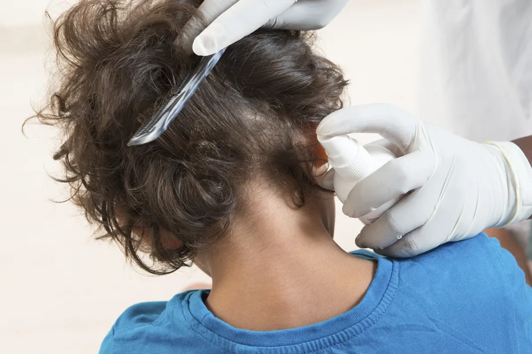 Kako odstraniti naglavne uši s pomočjo narave