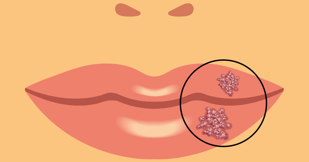 Herpes