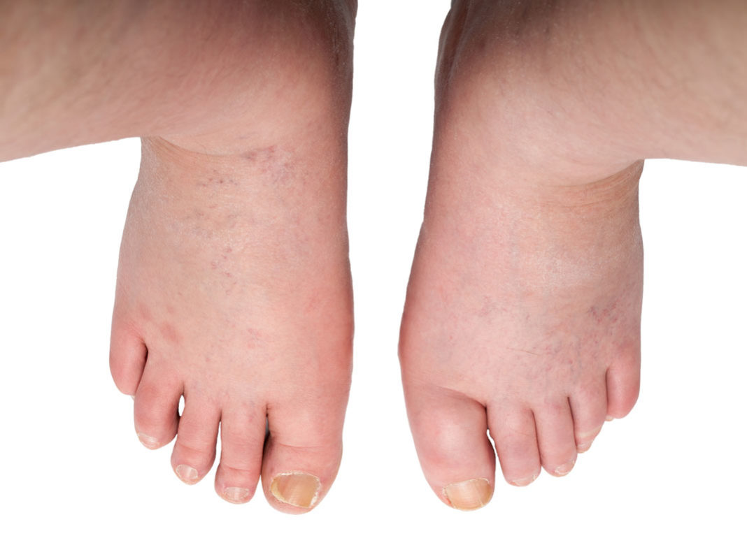 Zastajanje vode v telesu