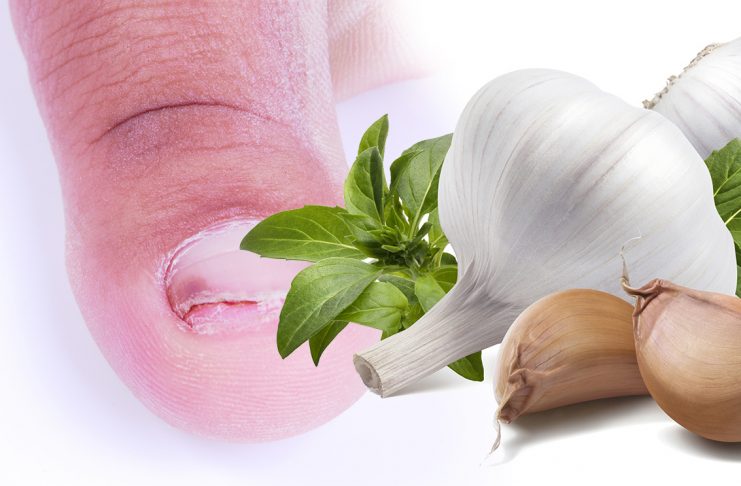 Vraščen noht - pomaga nam lahko česen