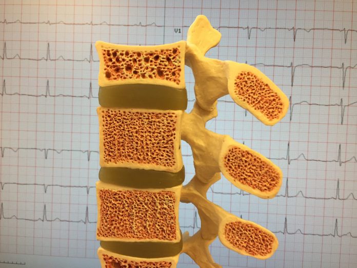 Osteoporoza kosti