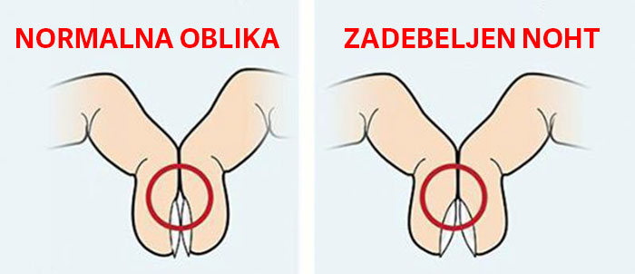 Ali lahko prsti razkrivajo pljučnega raka