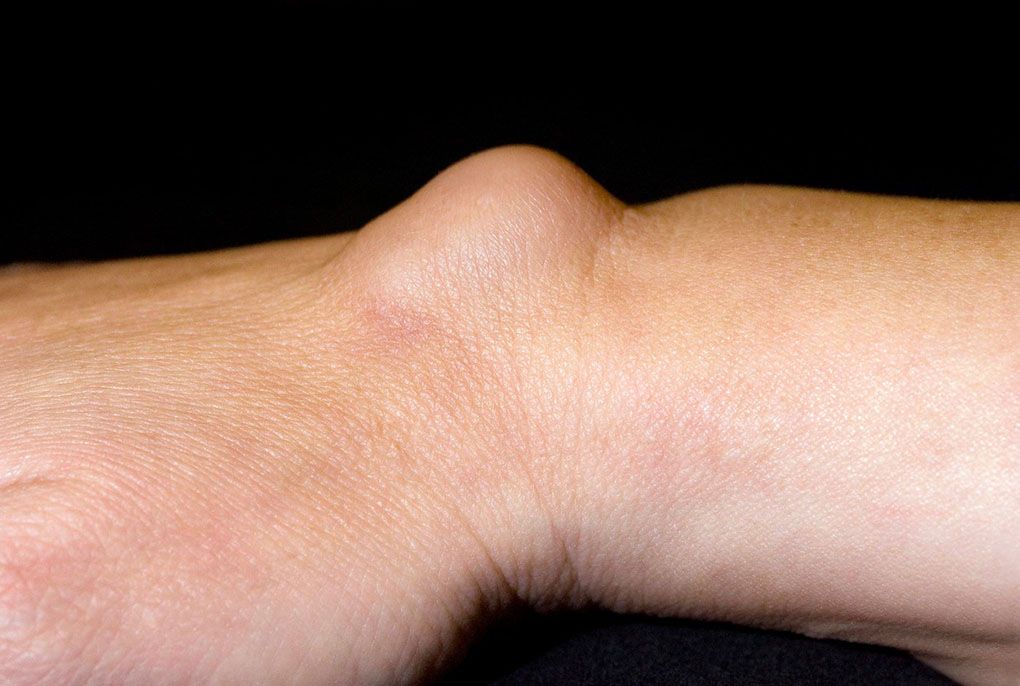 Ganglioni ganglionske ciste