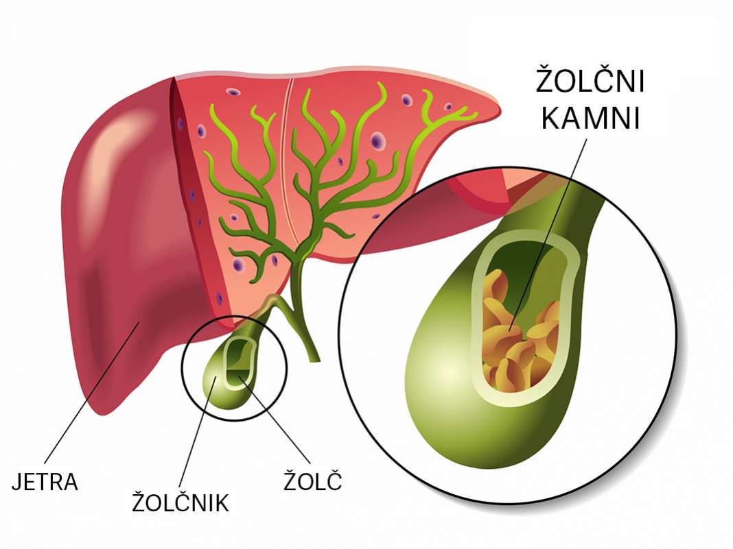Žolčni kamni