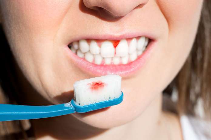 Gingivitis naravna pomoč