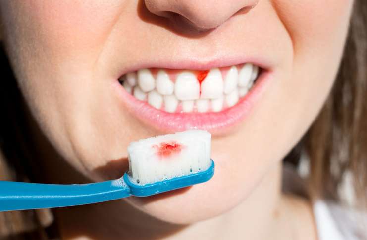 Gingivitis naravna pomoč