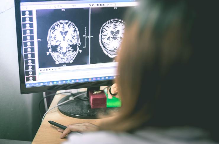 Protiamiloidna terapija Alzheimerjeva bolezen
