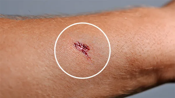 Ti znaki se zdijo nedolžni, a lahko kažejo na začetek te bolezni