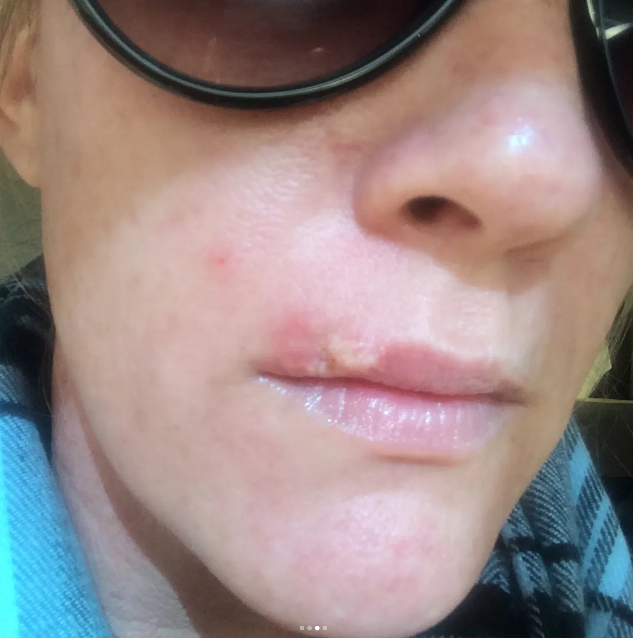 Iz mozolja je zrastel tumor