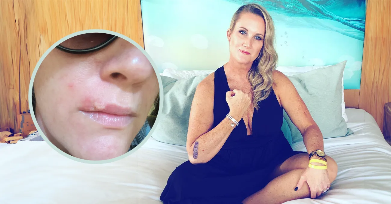 Mozolj na ustnici se je v samo dveh tednih spremenil v tumor