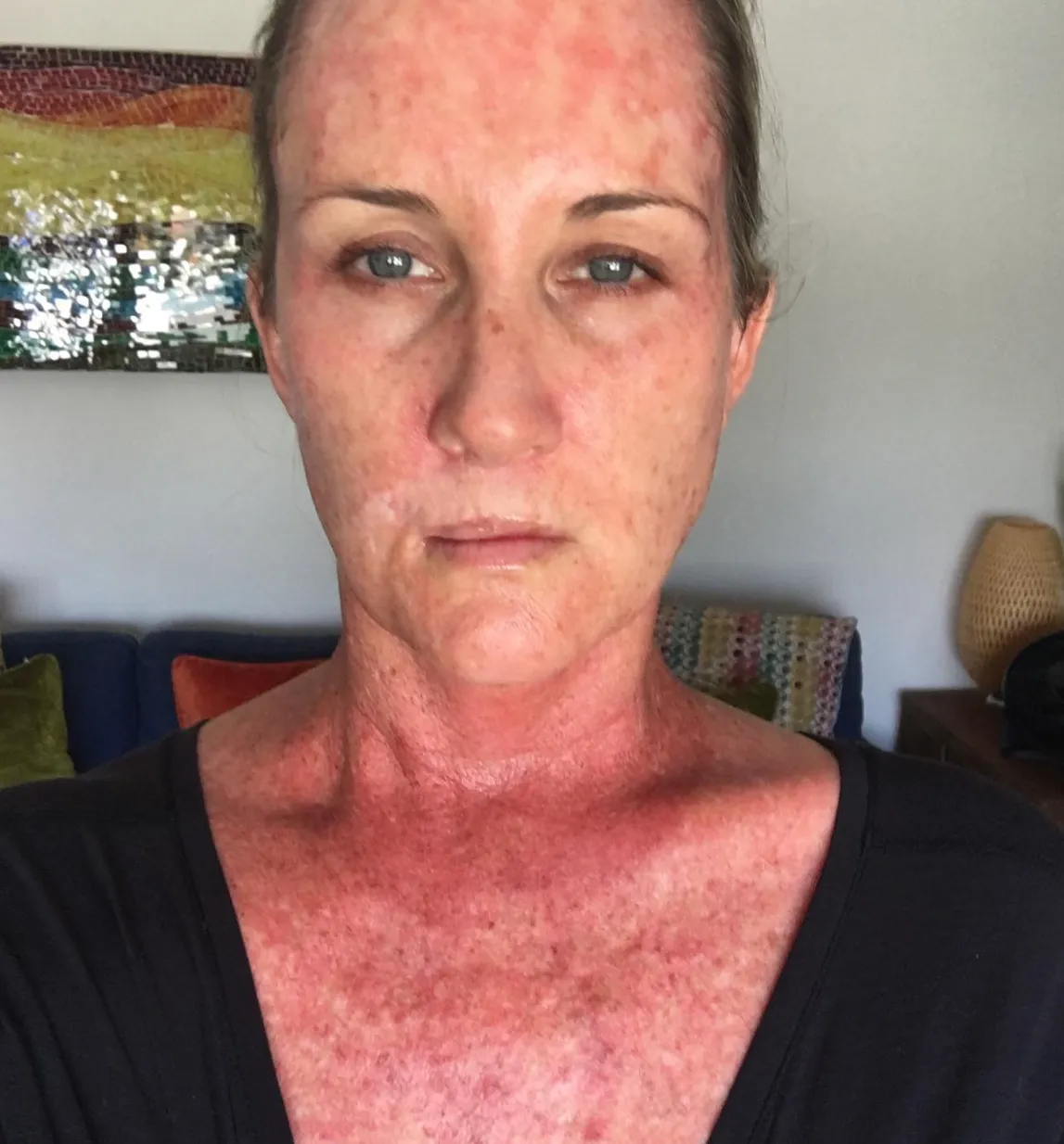 Kory Feltz po obsevanjih